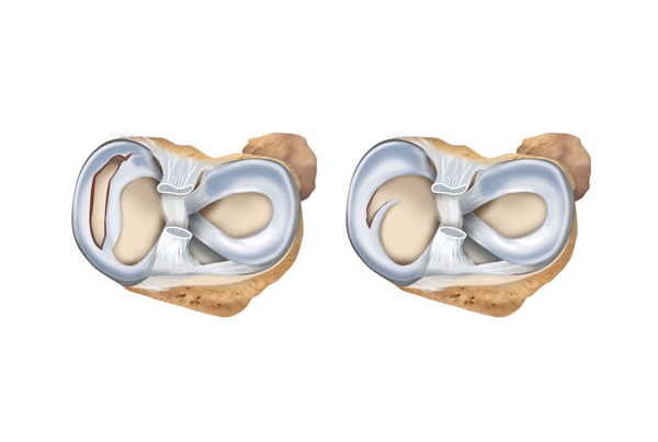 Meniscus