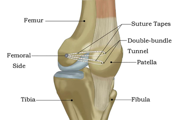 MPFL Injury