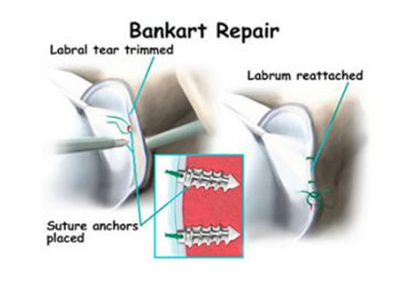 Bankart