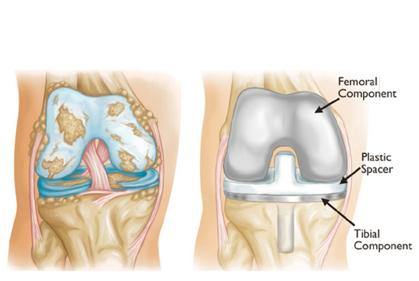 Total Knee Replacement