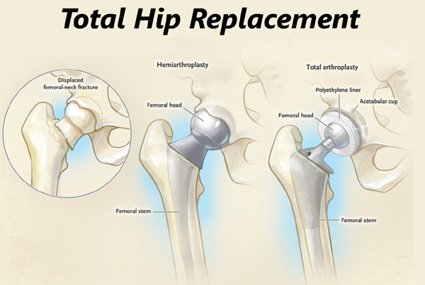 Total Hip Replacement