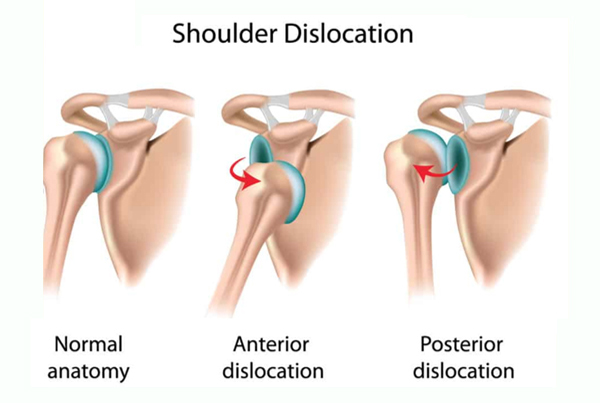 Reduce Shoulder