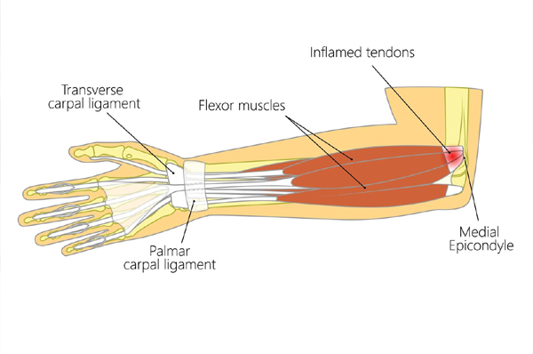 Elbow Replacement