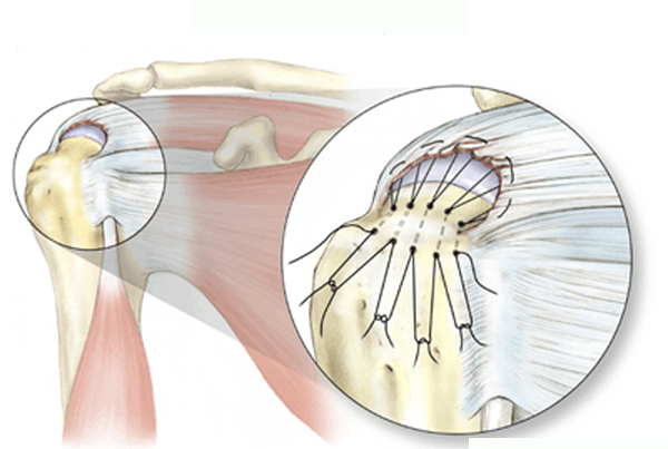 R C Injury